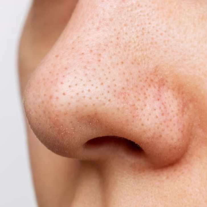 Tak perlu diekstraksi pakai pore pack, cara basmi komedo ini bikin pori-pori mengecil dan lebih bersih