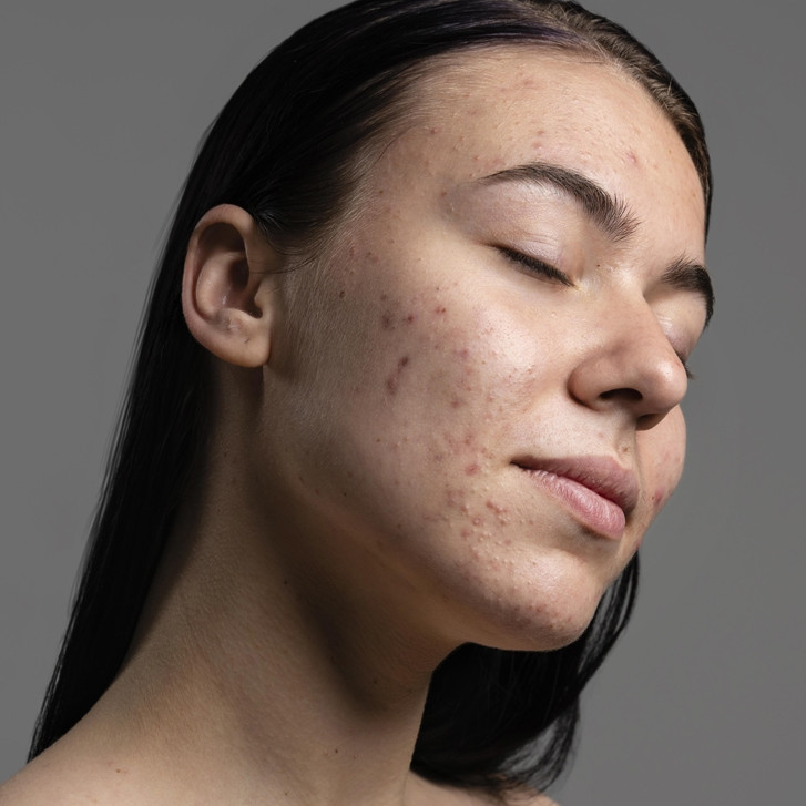 Bekas jerawat hilang dalam 3 hari, wanita ini cuma pakai masker alami dari 3 bahan dapur