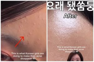 Cewek Korea ini bagikan rahasia hilangkan beruntusan dalam 4 hari, ternyata cuma pakai 1 bahan alami