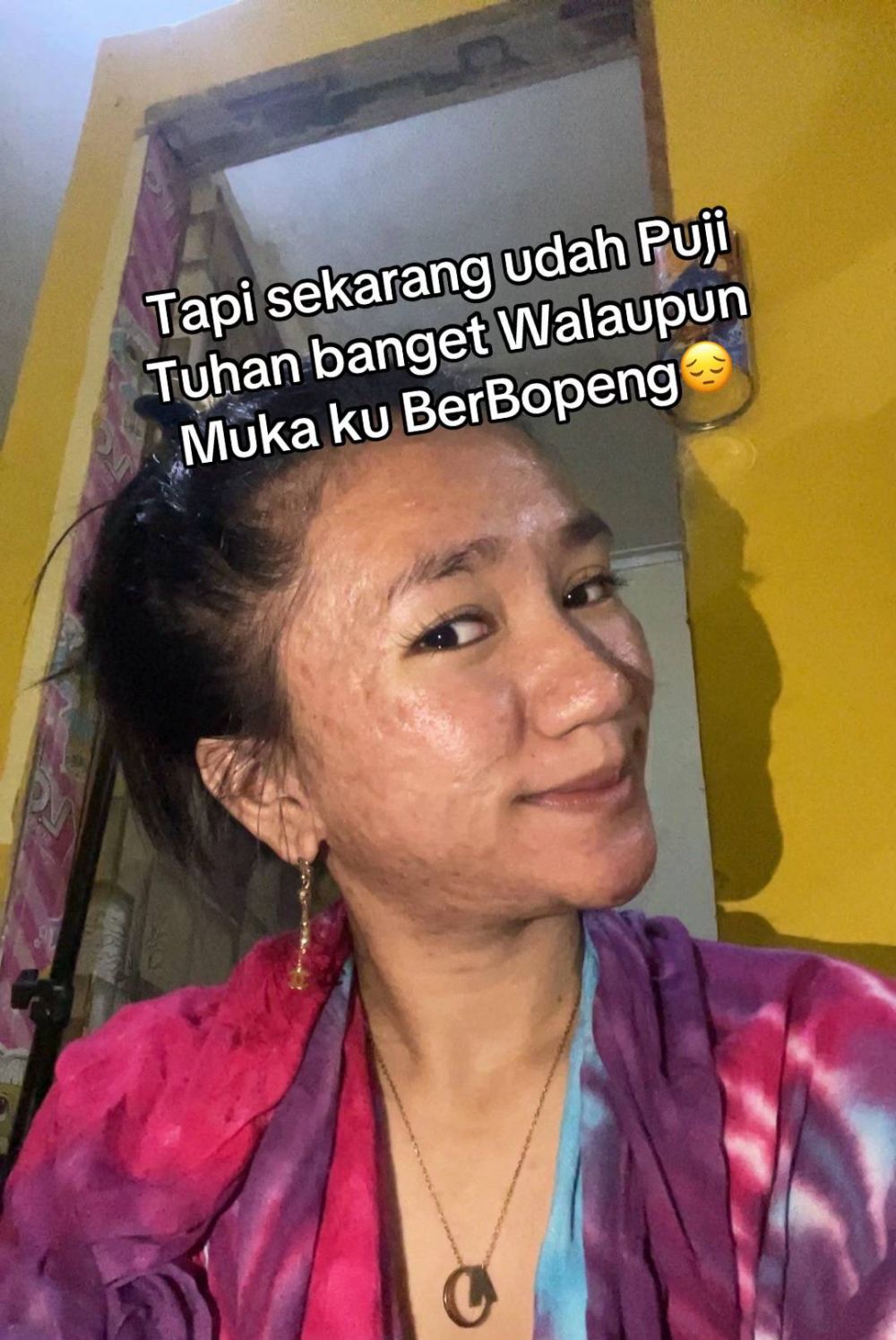 Menyesal pakai krim merkuri, 7 transformasi wajah wanita dulu mulus kini penuh bopeng ini bikin miris