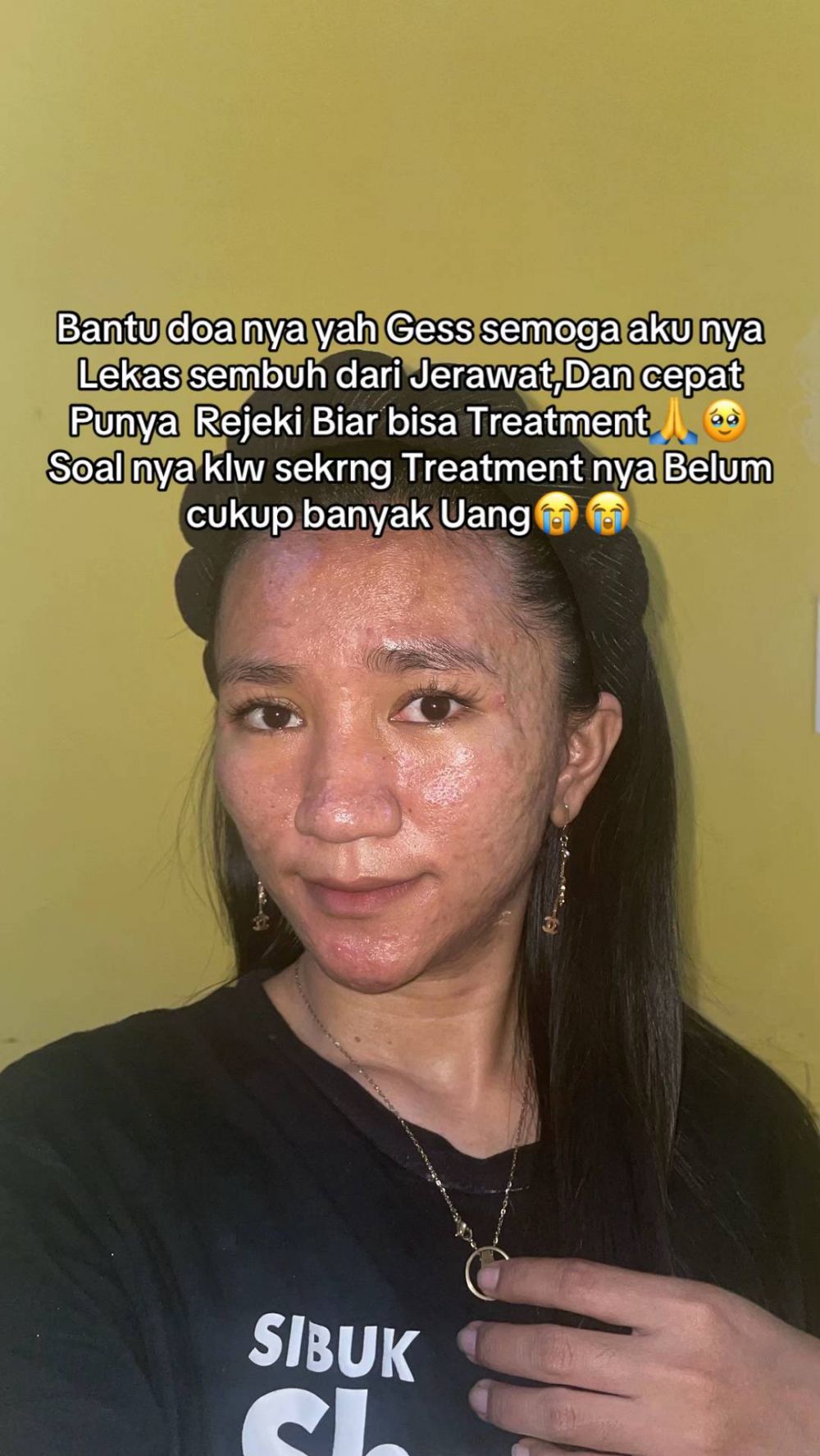 Menyesal pakai krim merkuri, 7 transformasi wajah wanita dulu mulus kini penuh bopeng ini bikin miris