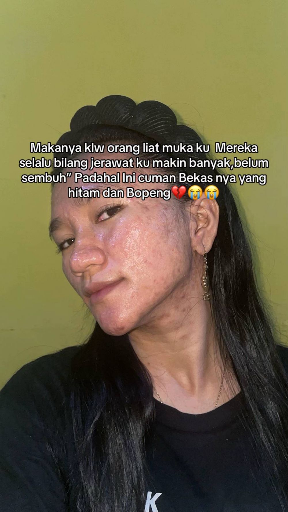Menyesal pakai krim merkuri, 7 transformasi wajah wanita dulu mulus kini penuh bopeng ini bikin miris