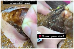 Tak perlu beli lagi, begini cara bikin pore pack yang ampuh bersihkan komedo dalam sekali pakai