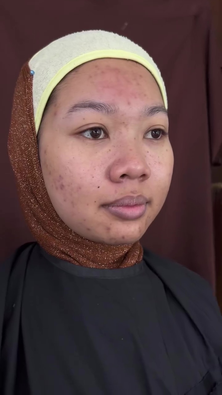 Hasilnya cantik paripurna, transformasi makeup cewek berjerawat dirias fresh look ini bikin melongo