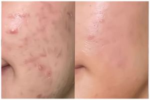 Aman untuk ibu hamil, ini cara alami hilangkan jerawat dalam 3 hari cuma pakai 1 kulit buah