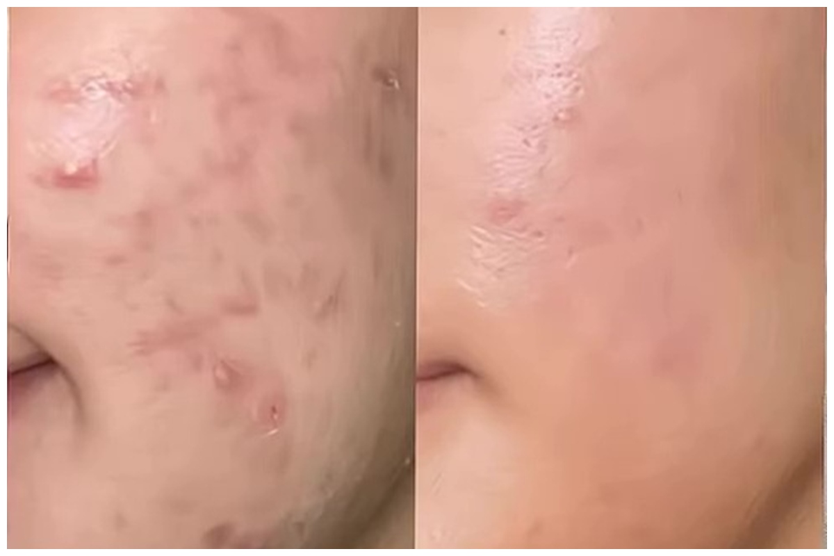 Aman untuk ibu hamil, ini cara alami hilangkan jerawat dalam 3 hari cuma pakai 1 kulit buah
