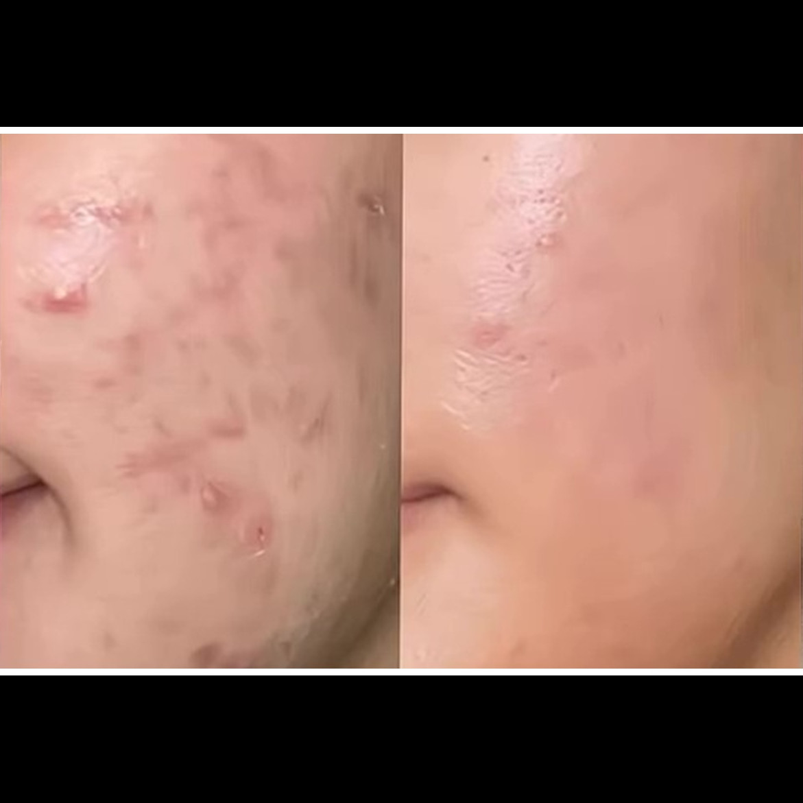 Aman untuk ibu hamil, ini cara alami hilangkan jerawat dalam 3 hari cuma pakai 1 kulit buah