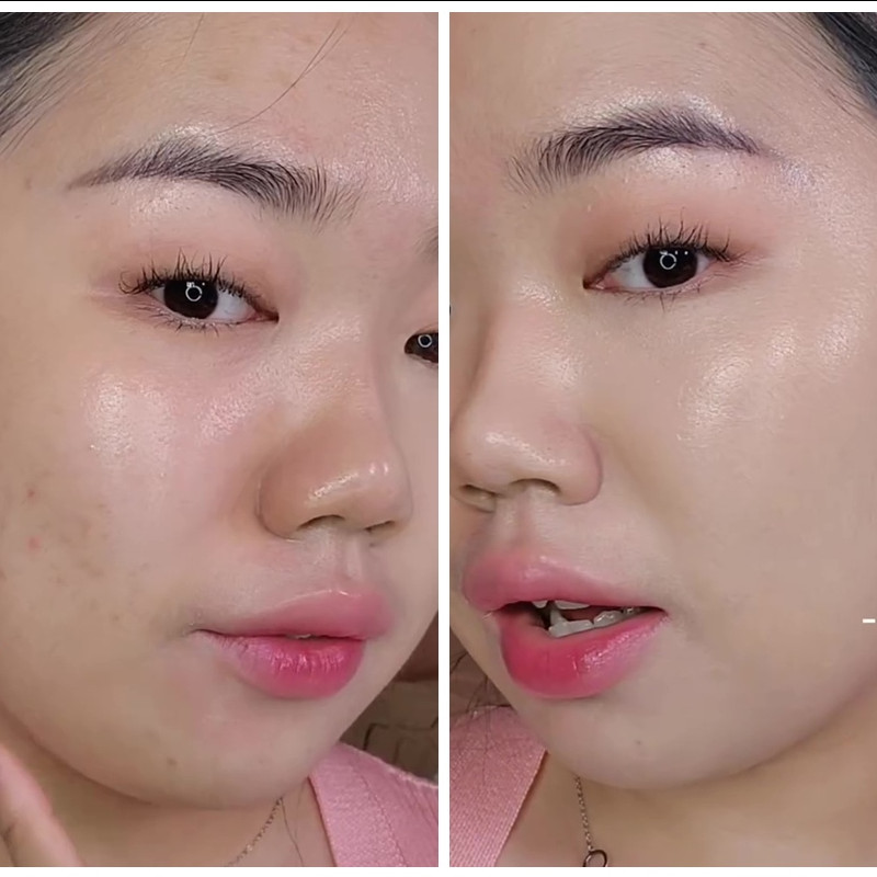 Jangan asal blend, ini cara ampuh samarkan bekas jerawat dengan concealer agar tertutup maksimal