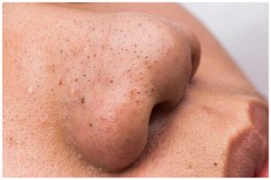 Tak perlu dikompres es batu dulu, ini cara ampuh hilangkan komedo hitam di hidung pakai 2 bahan dapur