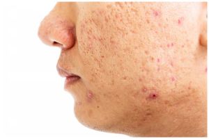 Wajah breakout jadi lebih mulus tanpa ke klinik, ini cara mengatasinya cuma dengan 1 jenis buah