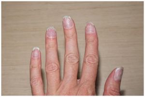 Kuku sering patah dan jamuran? Ini cara ampuh mengatasinya cuma dengan 2 bahan dapur