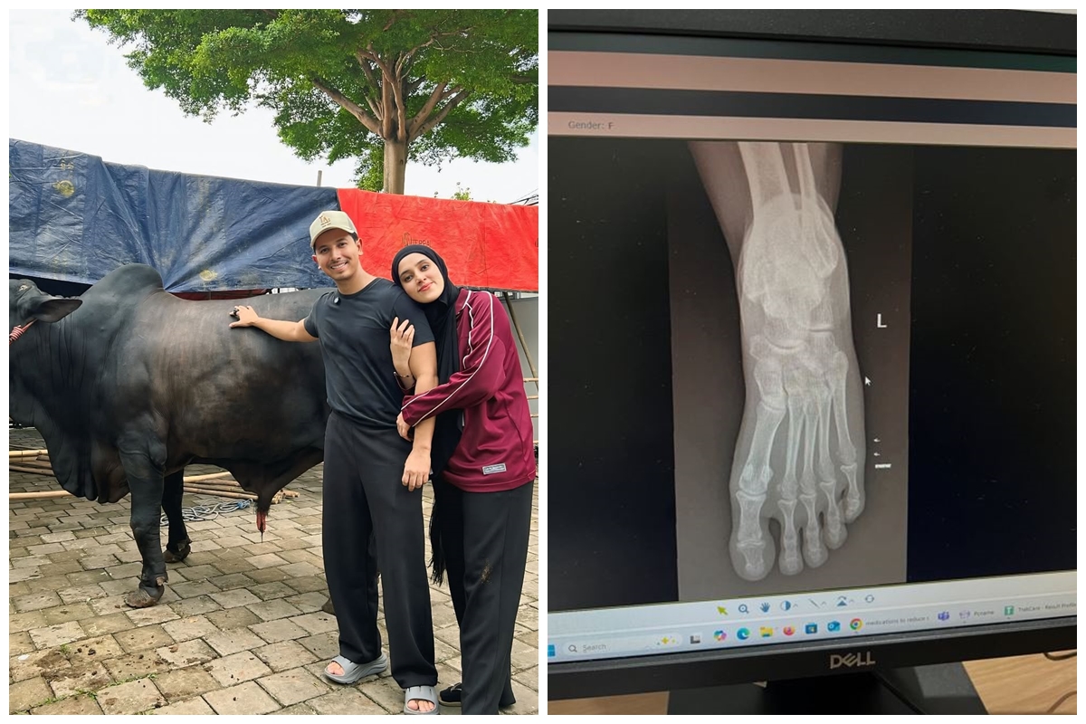 Kondisi Fairuz A Rafiq usai kakinya terinjak oleh sapi kurban dari Raffi Ahmad, alami memar
