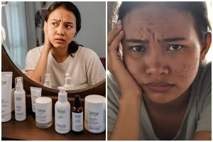 Sudah coba banyak skincare tapi gagal terus? Ini 5 kemungkinan penyebabnya