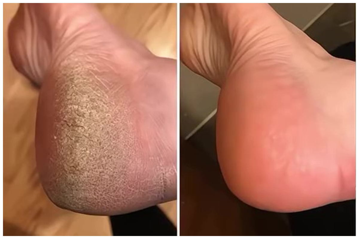 Tak perlu repot pakai lotion, ini cara ampuh atasi kaki kering dan pecah-pecah bermodal 2 bahan dapur