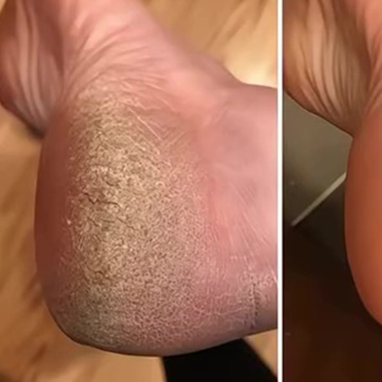Tak perlu repot pakai lotion, ini cara ampuh atasi kaki kering dan pecah-pecah bermodal 2 bahan dapur