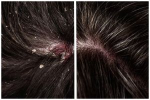 Jangan cuma pakai sampo, ini cara alami dan ampuh hilangkan ketombe di rambut pakai 2 bahan dapur