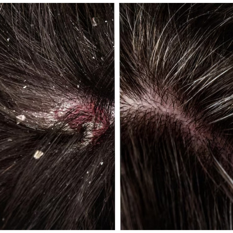 Jangan cuma pakai sampo, ini cara alami dan ampuh hilangkan ketombe di rambut pakai 2 bahan dapur