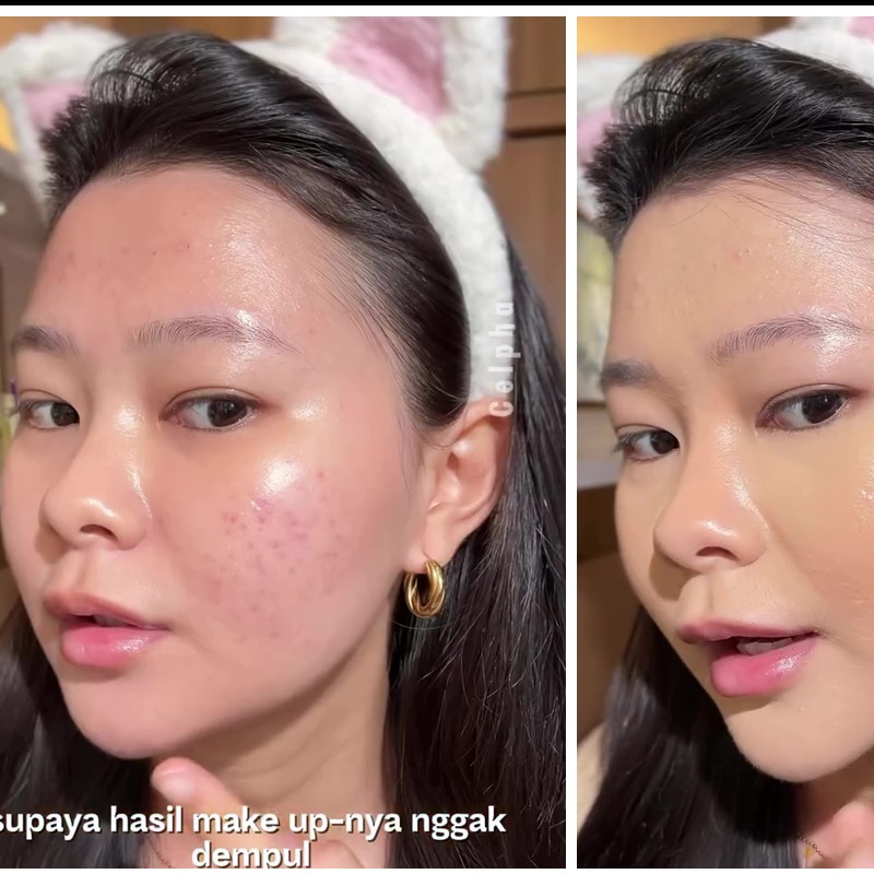 Concealer malah bikin bekas jerawat makin terlihat? Ini cara mengatasinya tanpa perlu tambahan produk