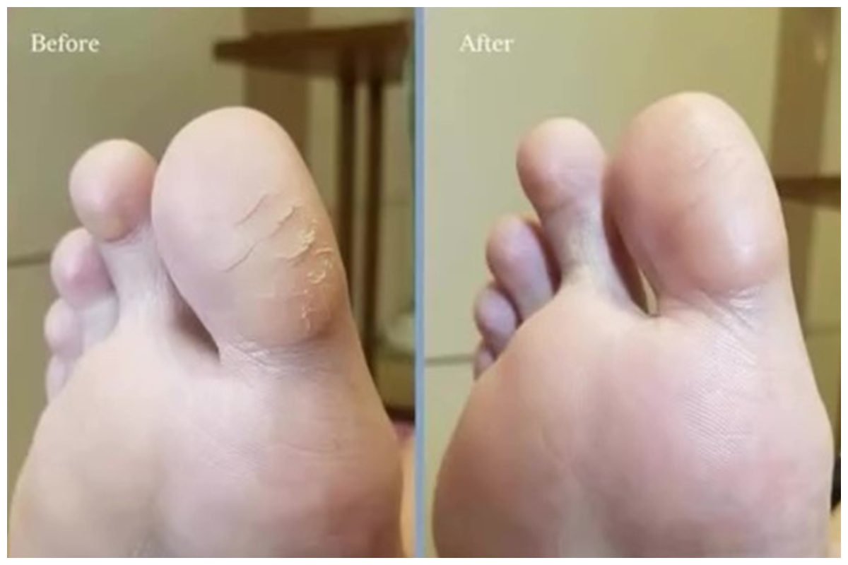 Kaki kering dan pecah-pecah langsung hilang dalam semalam, begini triknya cuma dengan 2 bahan