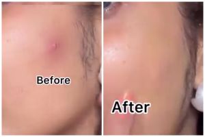 Tak perlu produk mahal, ini cara bikin acne patch untuk hilangkan jerawat cuma pakai 2 bahan dapur