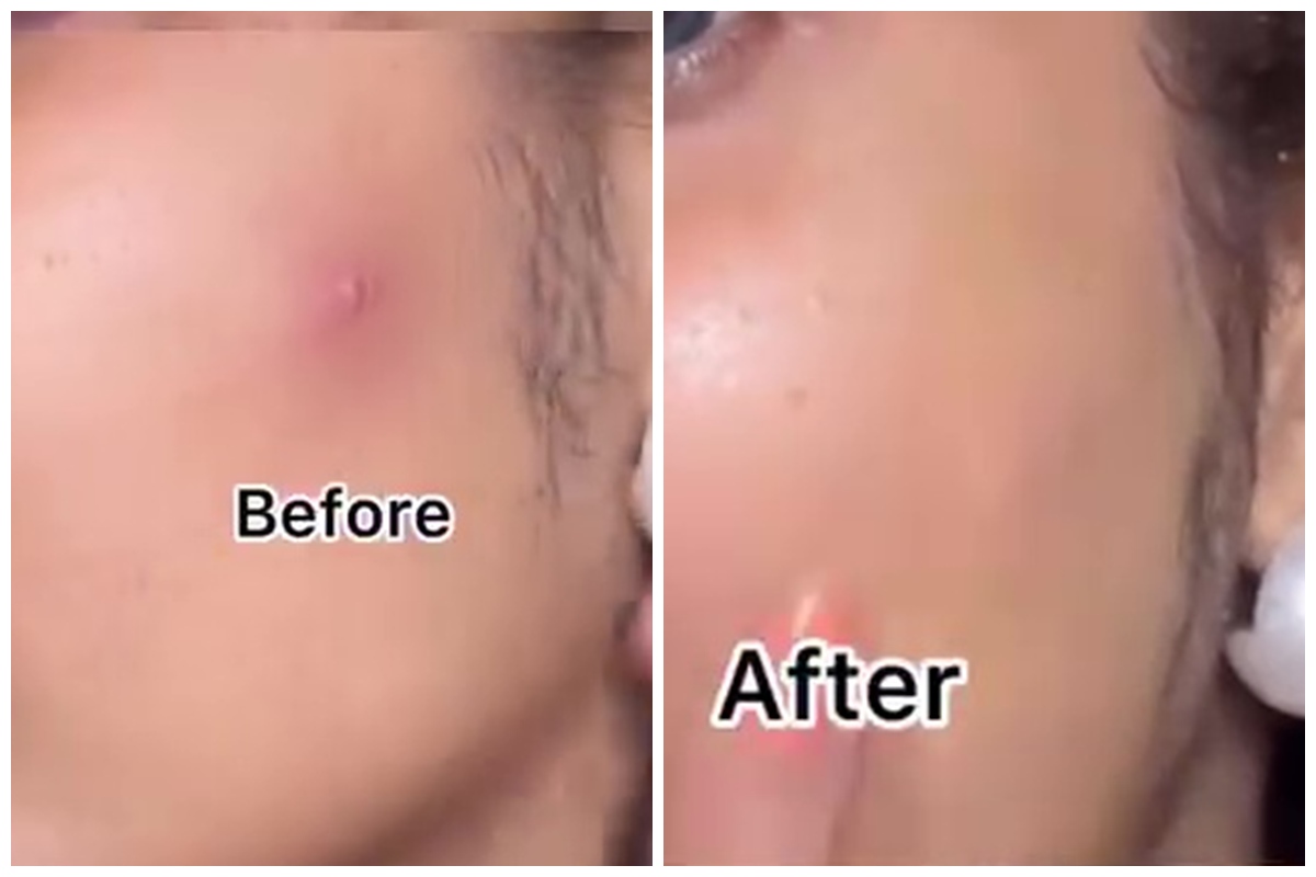 Tak perlu produk mahal, ini cara bikin acne patch untuk hilangkan jerawat cuma pakai 2 bahan dapur