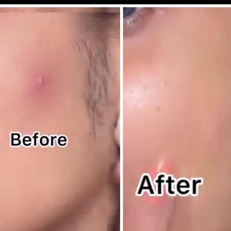 Tak perlu produk mahal, ini cara bikin acne patch untuk hilangkan jerawat cuma pakai 2 bahan dapur