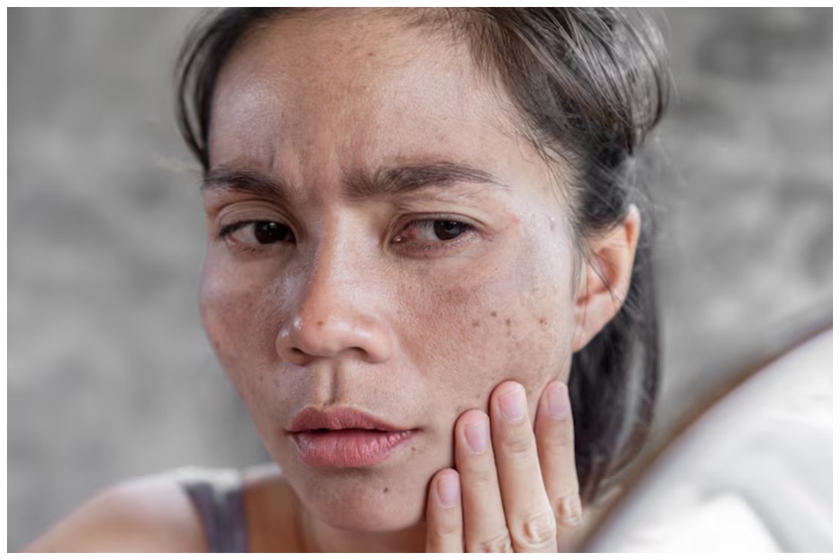 Cara baru hilangkan flek hitam wajah tanpa perlu ke klinik, ampuh cuma pakai 1 jenis umbi-umbian ini