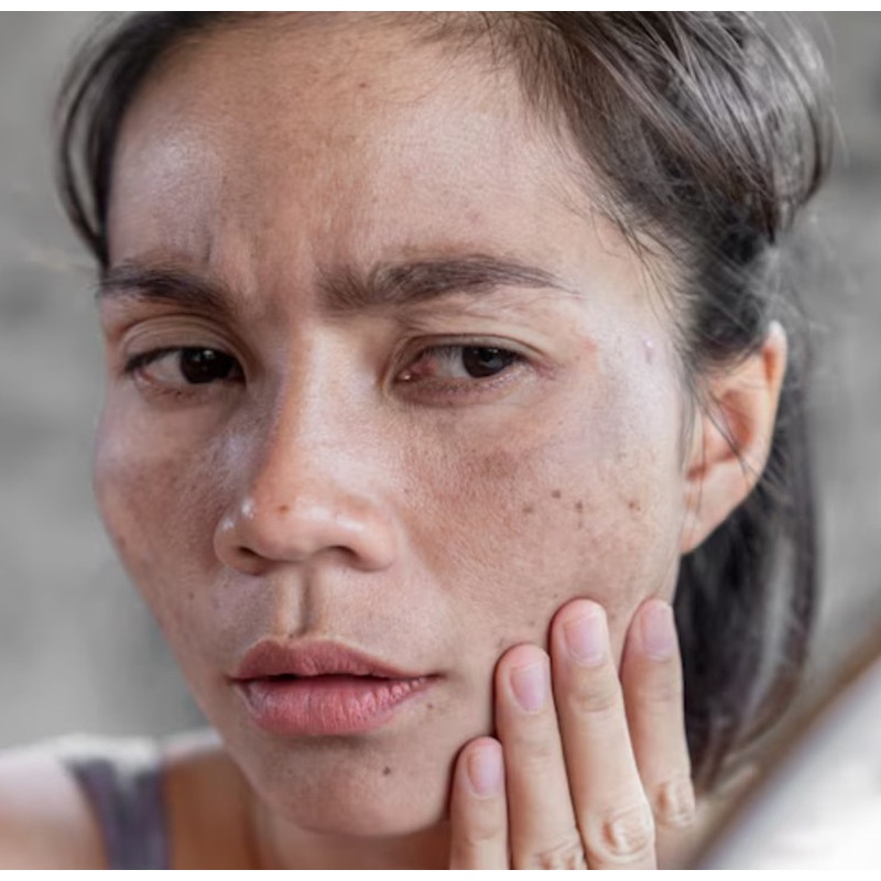 Cara baru hilangkan flek hitam wajah tanpa perlu ke klinik, ampuh cuma pakai 1 jenis umbi-umbian ini