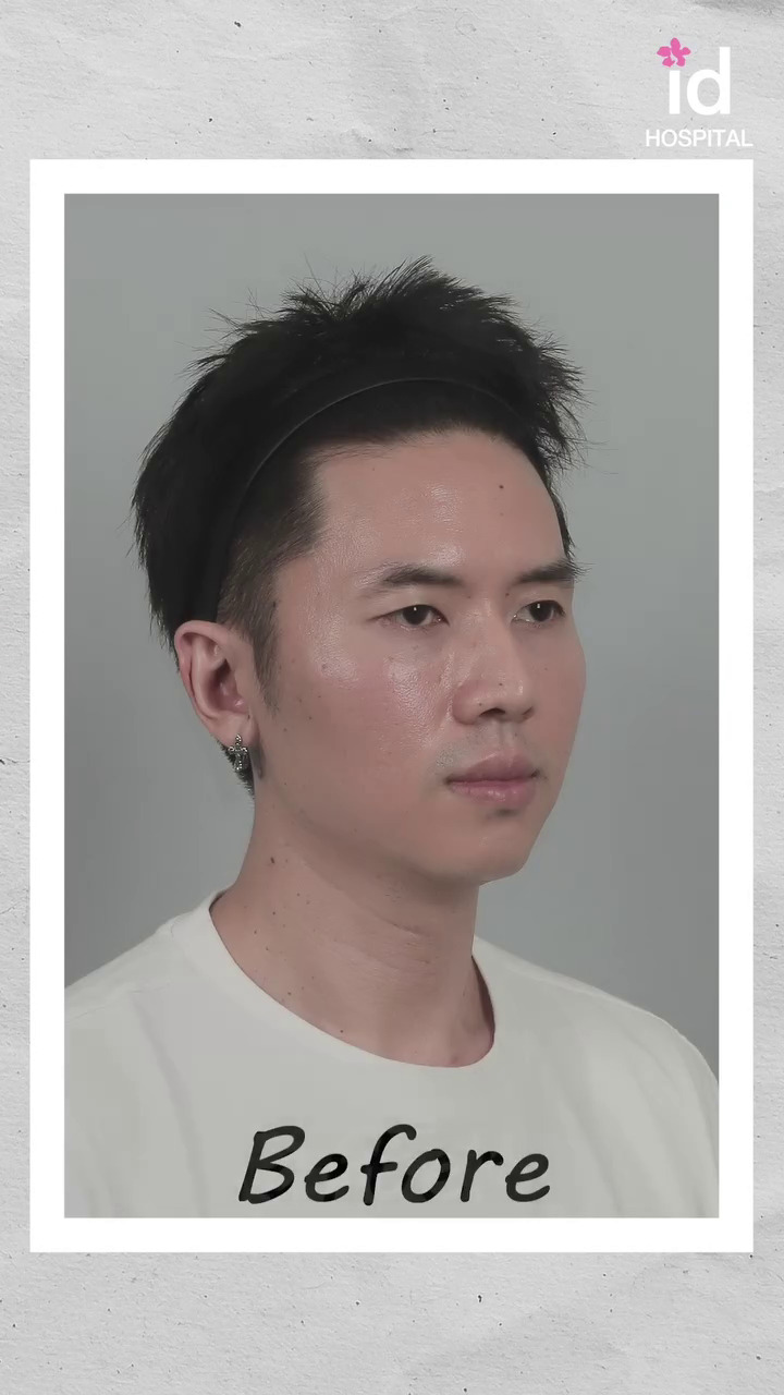 9 Potret transformasi Rafael Tan usai jalani oplas, perubahannya matanya jadi sorotan