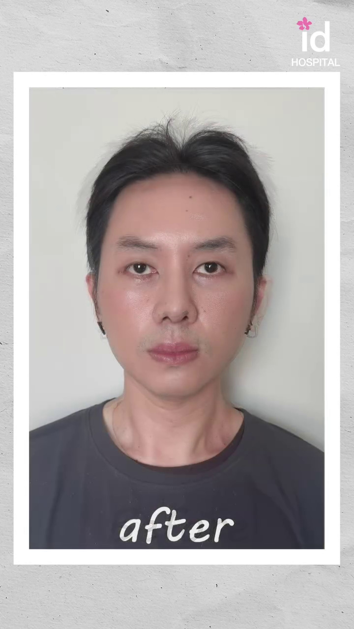 9 Potret transformasi Rafael Tan usai jalani oplas, perubahannya matanya jadi sorotan