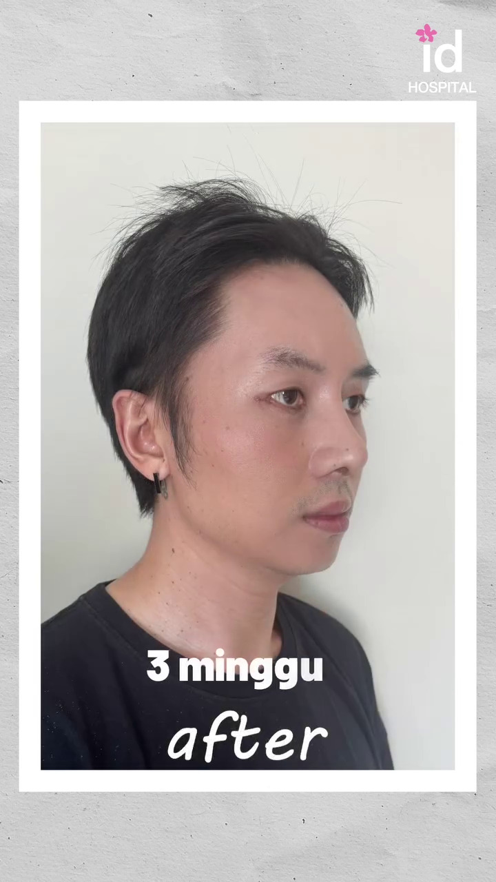 9 Potret transformasi Rafael Tan usai jalani oplas, perubahannya matanya jadi sorotan