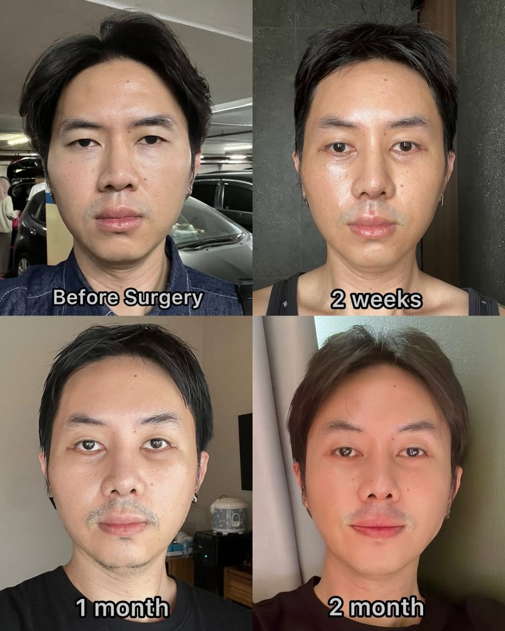 9 Potret transformasi Rafael Tan usai jalani oplas, perubahannya matanya jadi sorotan