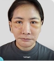 Yurike Prastika oplas anti-aging di Korea Selatan, 9 transformasinya jadi terlihat 10 tahun lebih muda