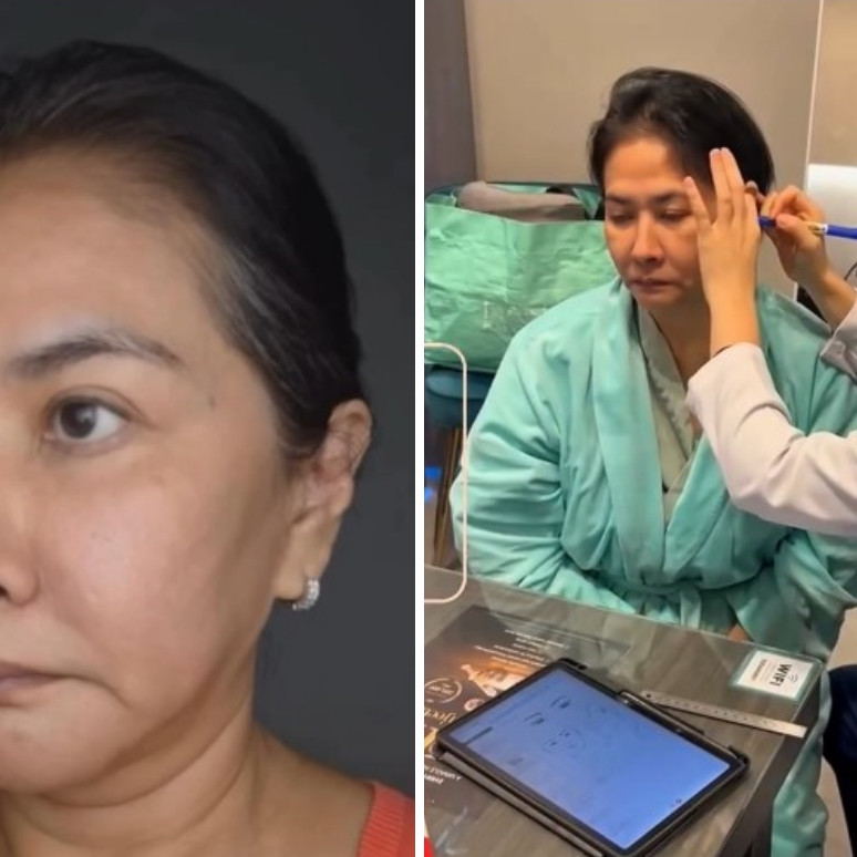 Yurike Prastika oplas anti-aging di Korea Selatan, 9 transformasinya jadi terlihat 10 tahun lebih muda