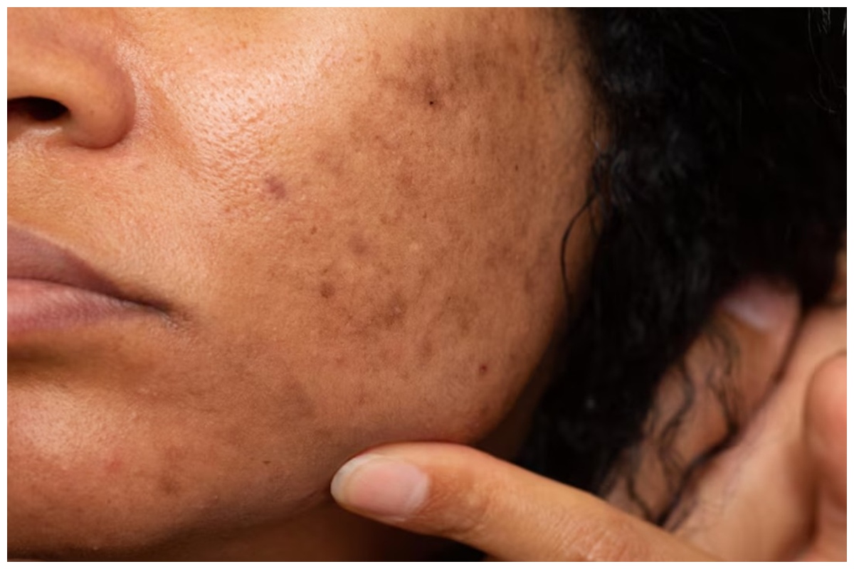 Flek hitam di wajah susah hilang? Masker dari 2 bahan dapur ini bisa ampuh bikin kulit mulus lagi