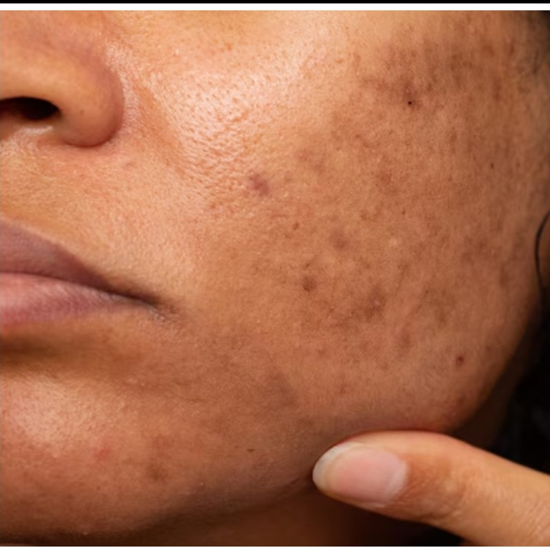 Flek hitam di wajah susah hilang? Masker dari 2 bahan dapur ini bisa ampuh bikin kulit mulus lagi