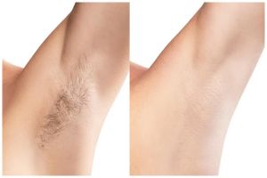 Cara ampuh hilangkan bulu ketiak secara permanen tanpa khawatir iritasi, cukup pakai 1 buah ini