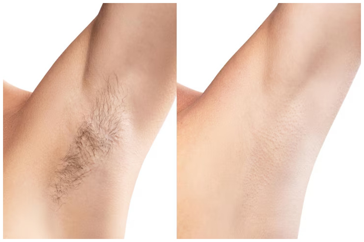 Cara ampuh hilangkan bulu ketiak secara permanen tanpa khawatir iritasi, cukup pakai 1 buah ini