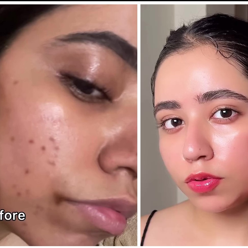 Jangan cuma direndam, ini cara bikin toner dari beras untuk hilangkan bekas jerawat dan flek hitam 