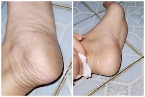 Tak perlu beli lotion, tumit pecah-pecah bisa kembali mulus dalam 5 menit cuma pakai 2 bahan dapur ini