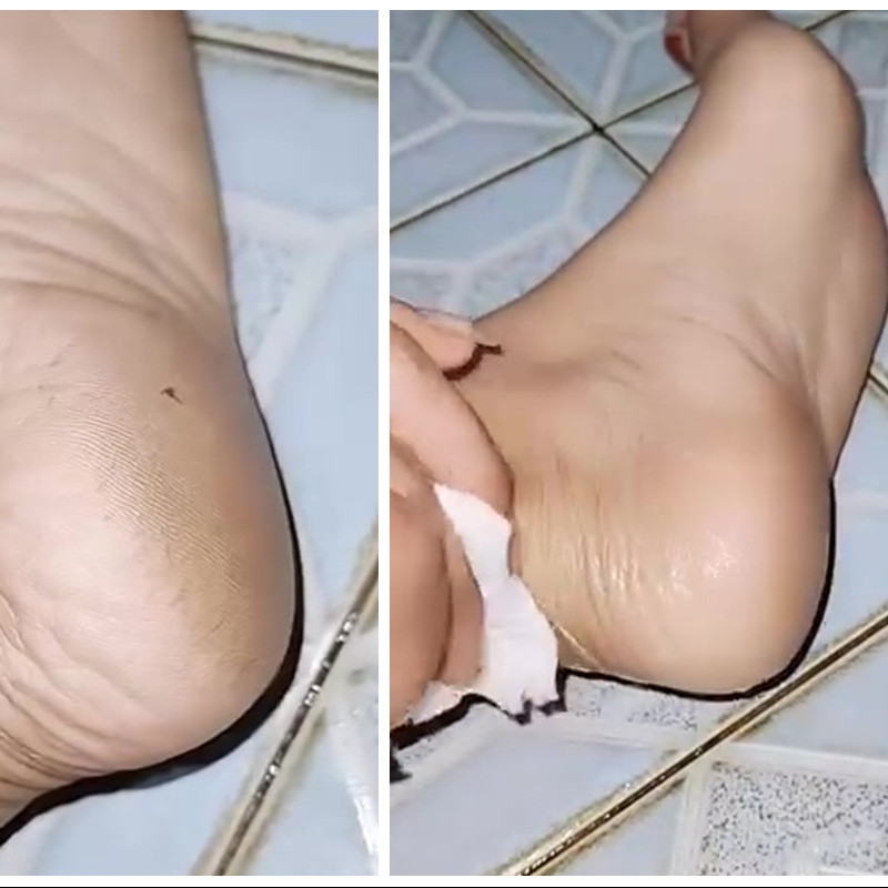 Tak perlu beli lotion, tumit pecah-pecah bisa kembali mulus dalam 5 menit cuma pakai 2 bahan dapur ini