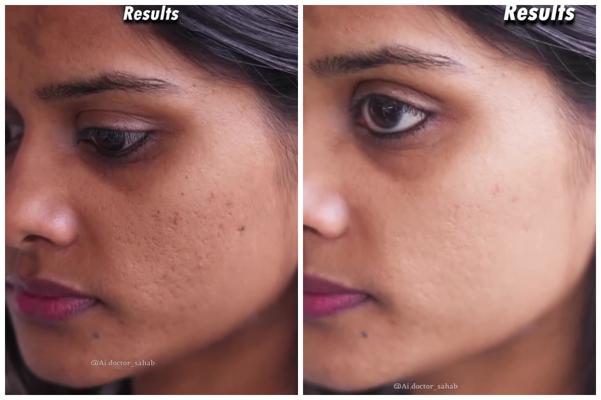 Tak perlu laser, ini cara mengatasi bopeng biar wajah mulus pakai masker dari 1 kulit buah