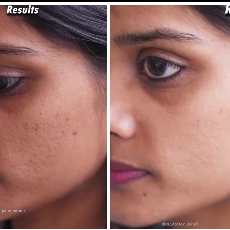 Tak perlu laser, ini cara mengatasi bopeng biar wajah mulus pakai masker dari 1 kulit buah