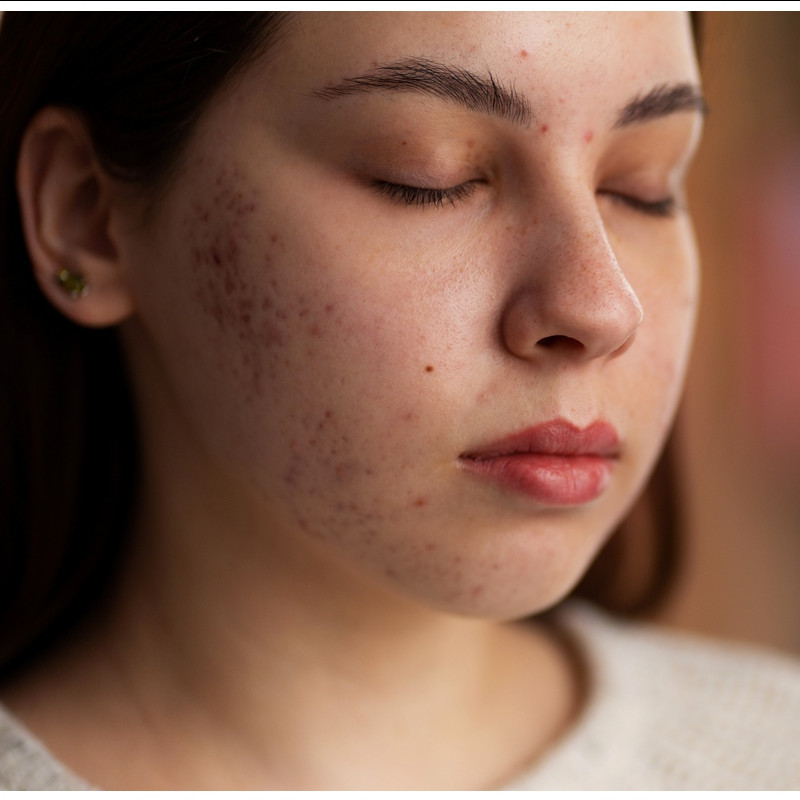 Tak banyak yang tahu, ternyata jenis rempah ini bisa ampuh samarkan bekas jerawat dalam hitungan hari