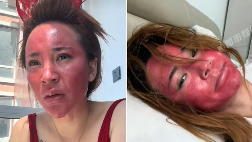 Tak hapus makeup selama 22 tahun wanita ini alami peradangan mengerikan di wajahnya, begini kondisinya