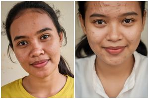 Jangan keliru, ini perbedaan pori-pori besar dan komedo serta cara mengatasinya