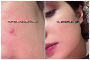 Bukan pakai acne patch, ini cara cepat menghilangkan jerawat aktif dalam 2 hari bermodal Rp0