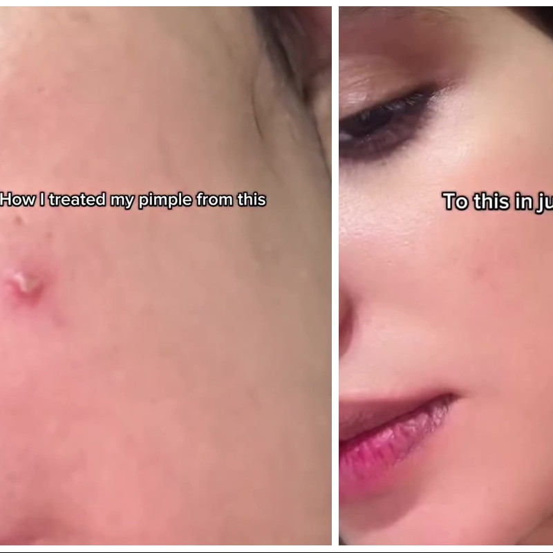 Bukan pakai acne patch, ini cara cepat menghilangkan jerawat aktif dalam 2 hari bermodal Rp0