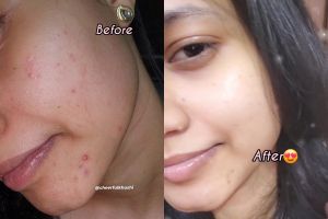 Kulit bertekstur bekas jerawat dan bruntusan? Begini cara mengatasinya agar mulus lagi dalam 10 hari
