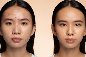Kulit cerah dan bebas jerawat, ini 7 tips skincare sederhana